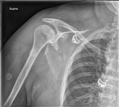 metal brackets on left scapula|scapula tip fracture.